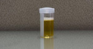 alterazioni della quantità di urine e monitoraggio urinario